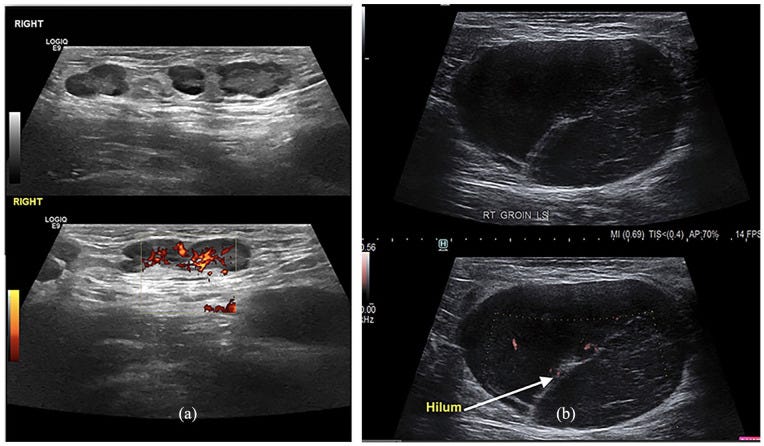 Hernia tempo formacion 1.jpg